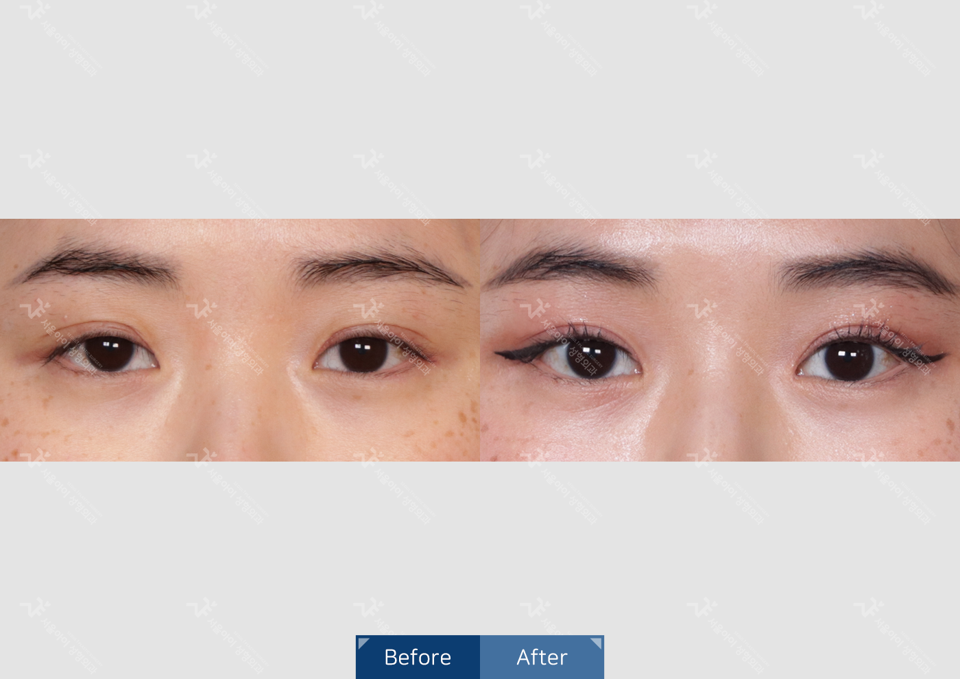 눈성형 [자연유착 쌍꺼풀]