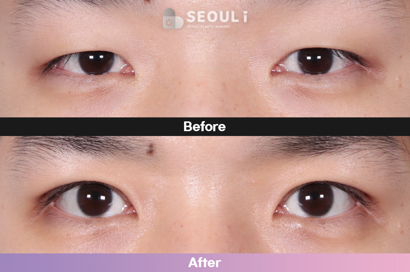 눈성형 [자연유착 쌍꺼풀 + 눈매교정]