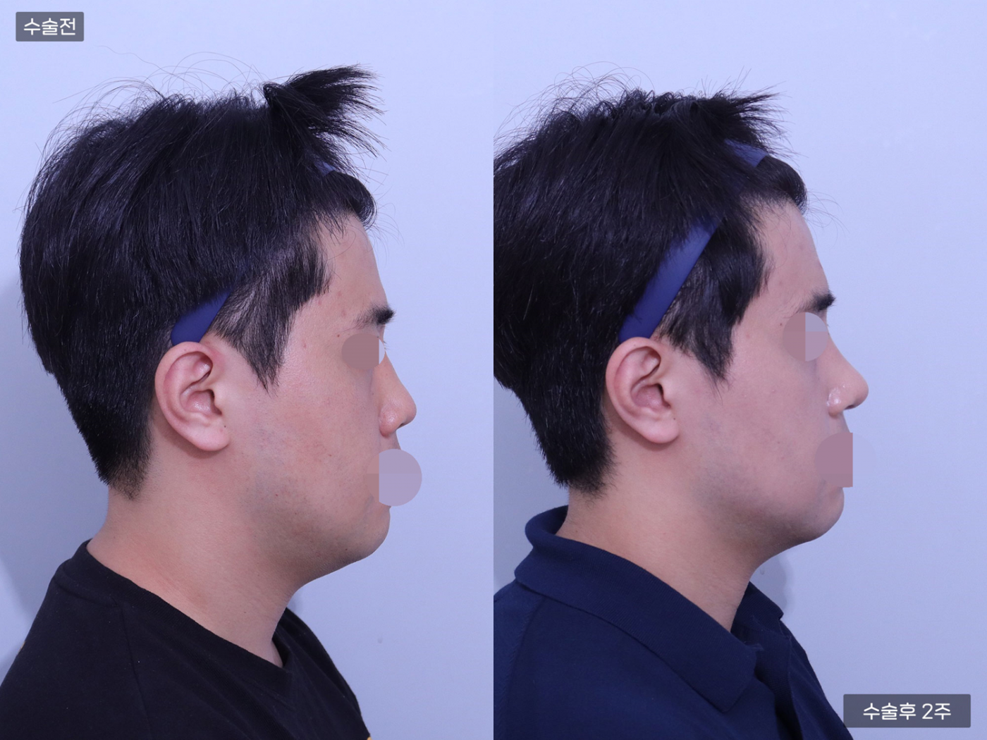 코끝 + 복코 + 매부리코