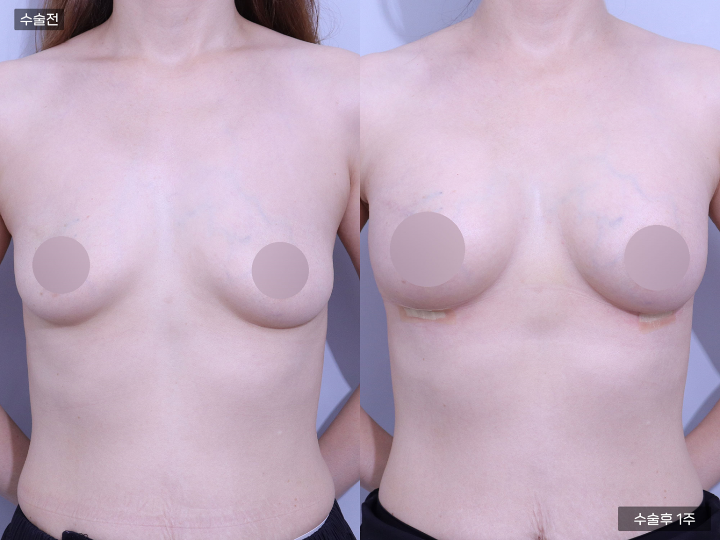 가슴성형 [내추럴가슴보형물]