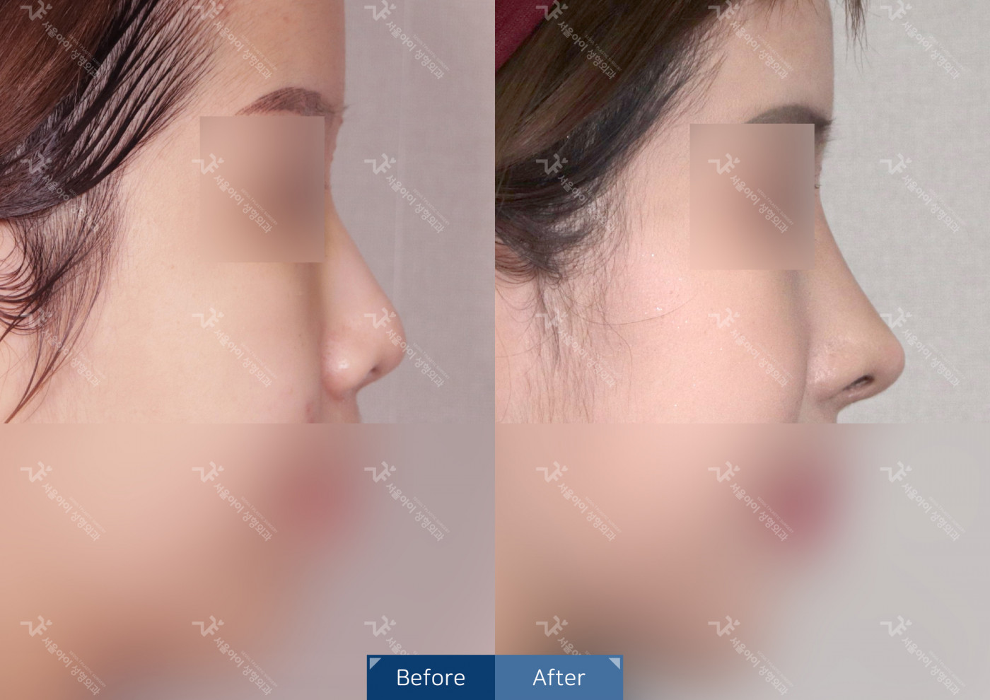 코성형 [코끝조각술(비중격)+복코교정+매부리코교정+콧볼축소술+축비술]