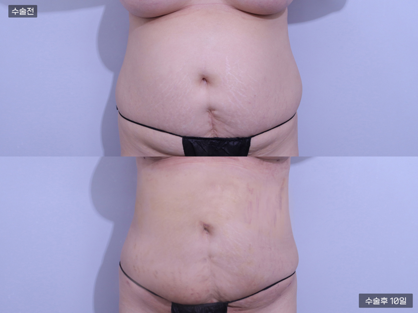 복부 지방흡입