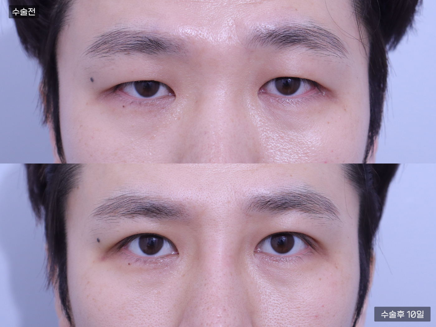 눈성형 [자연유착 쌍꺼풀 + 눈매교정]