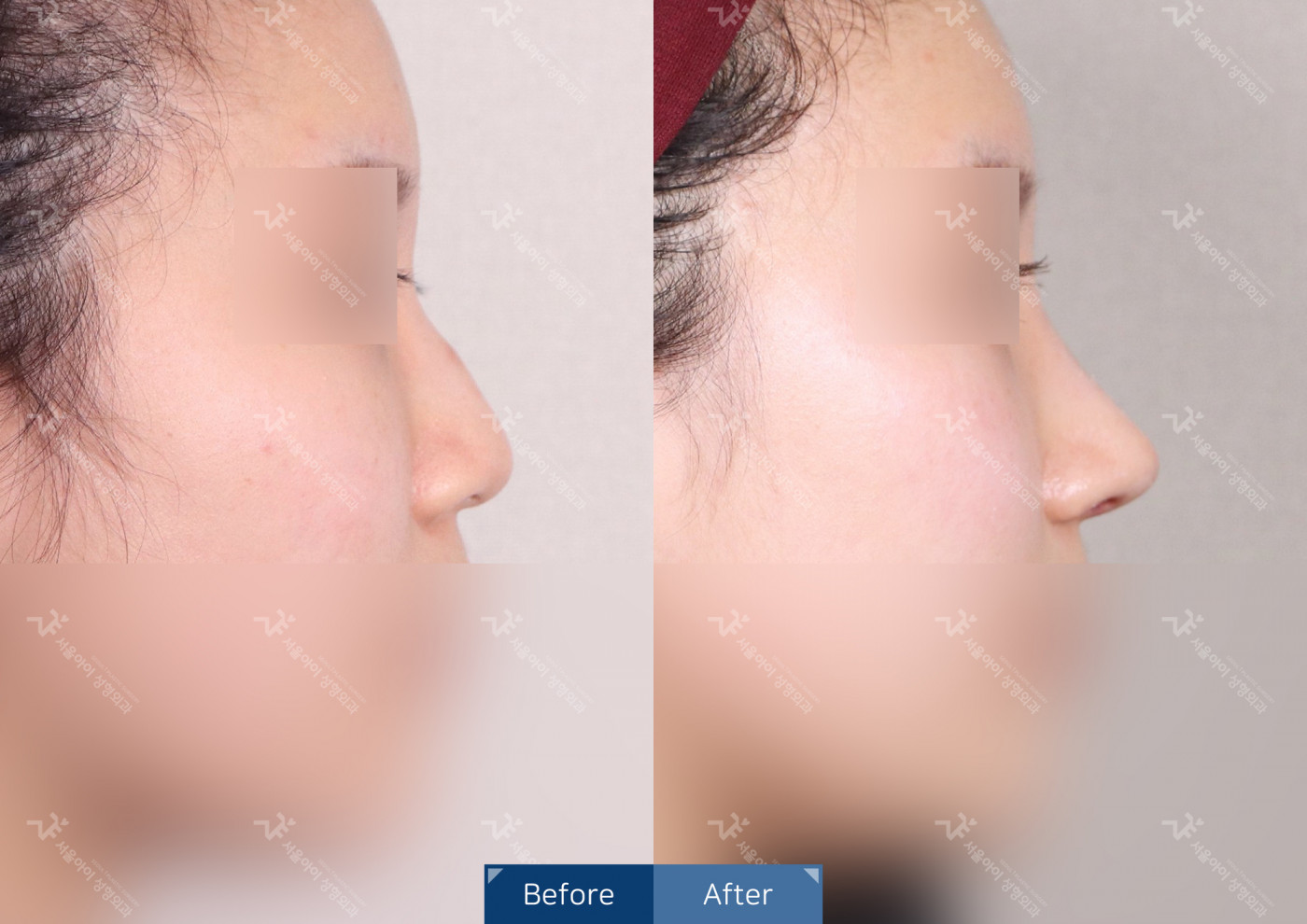 코성형 [코끝조각술(비중격)+복코교정+매부리코교정+비절개콧볼축소]