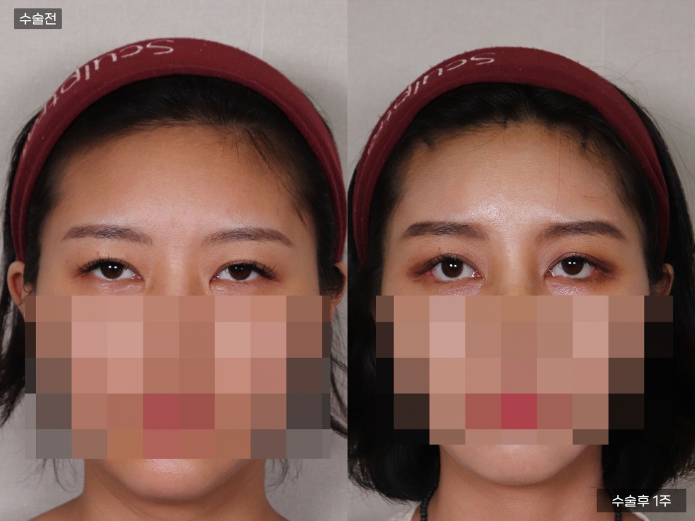 리프팅 [이마거상]