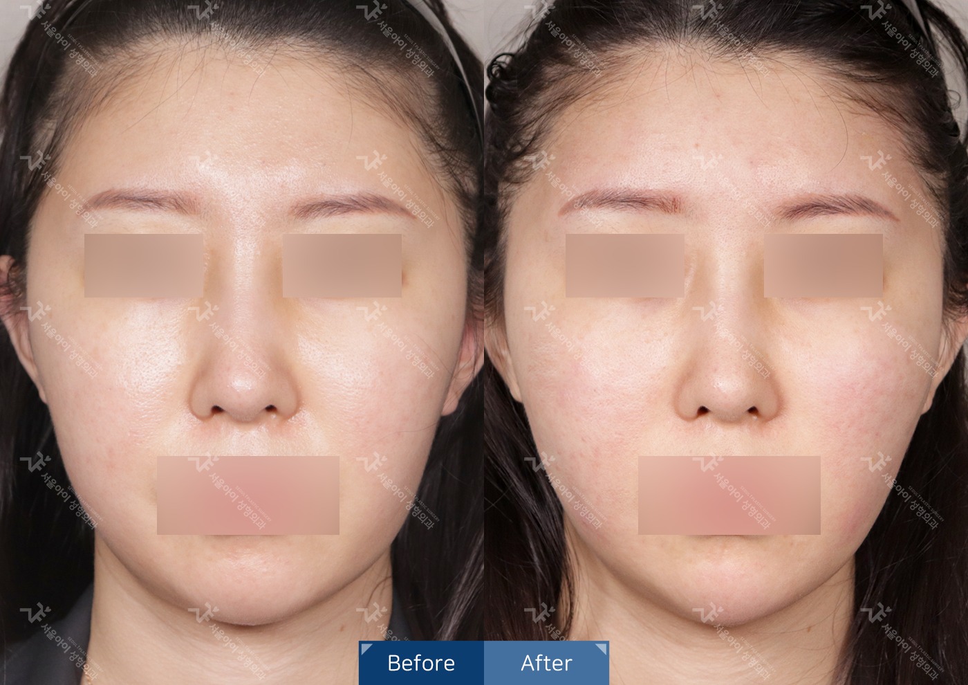 리프팅 [더블영 리프팅]