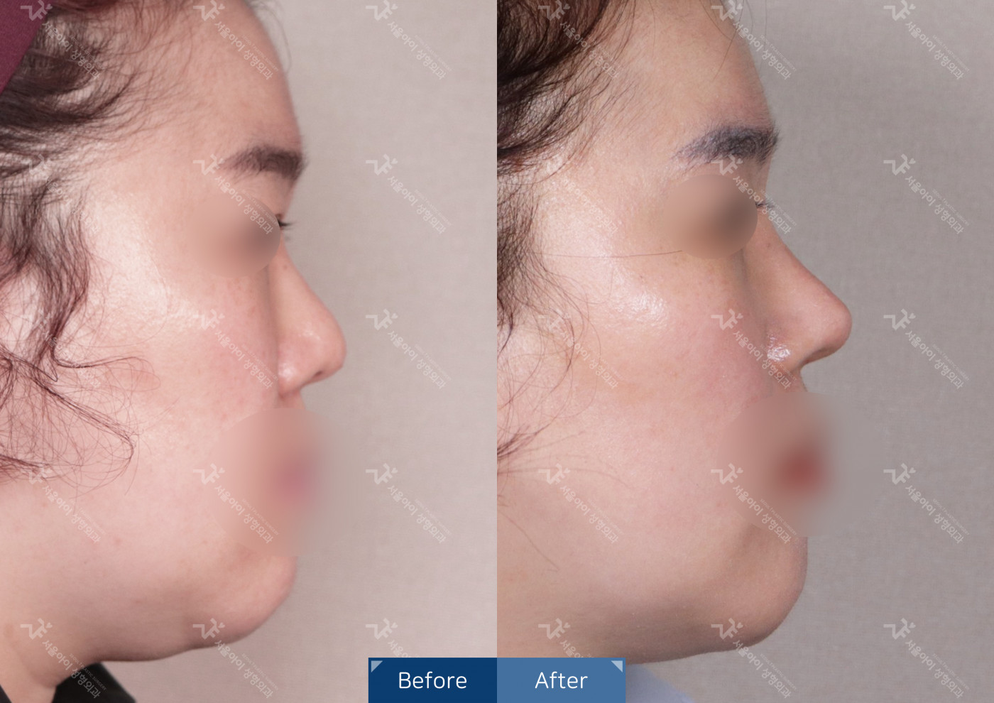 코성형[융비술&코끝조각술(비중격)+복코교정술+짧은코교정]