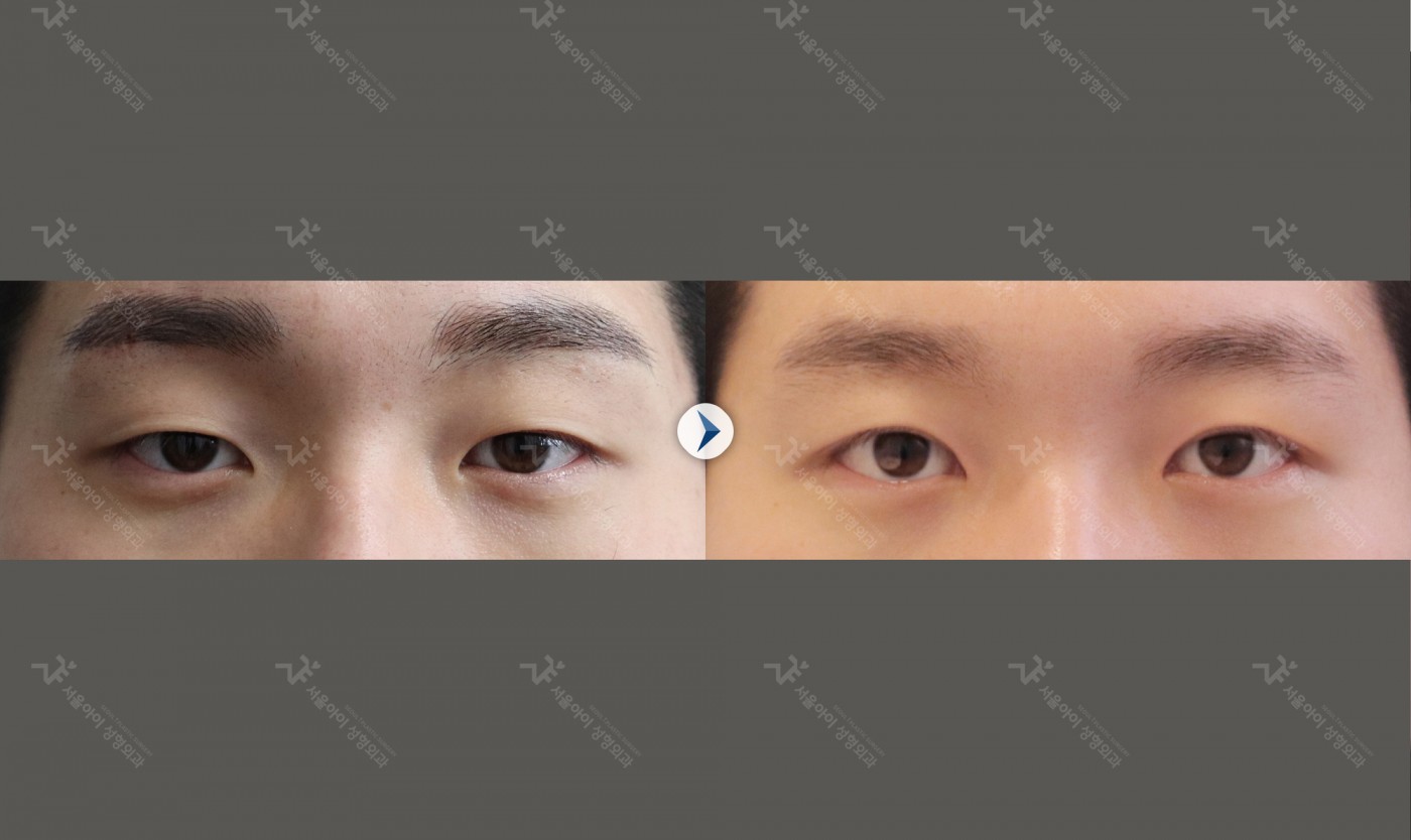 눈성형 [자연유착 쌍꺼풀 + 앞트임 + 뒷트임]