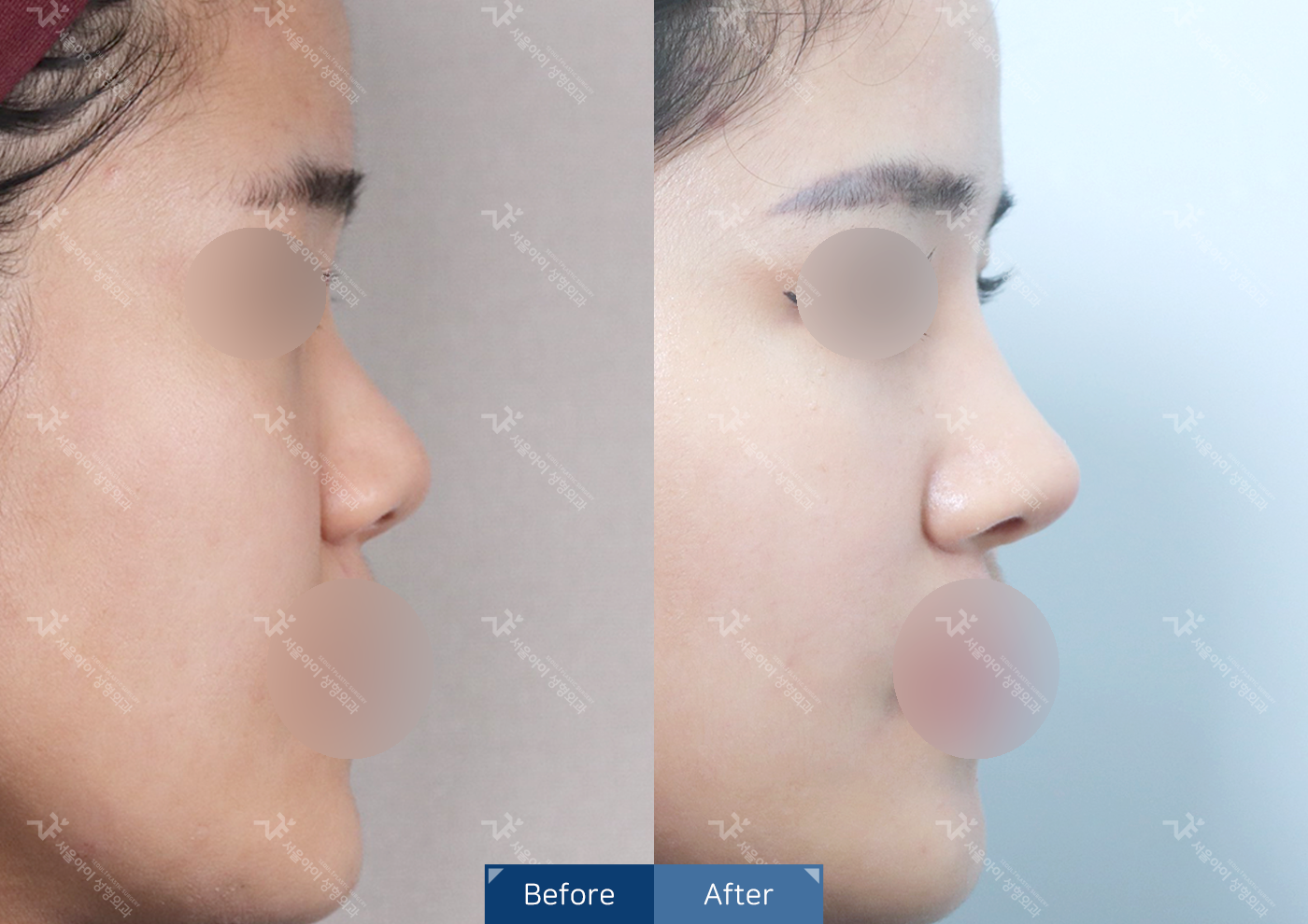콧대+코끝(비중격)+복코+짧은코교정