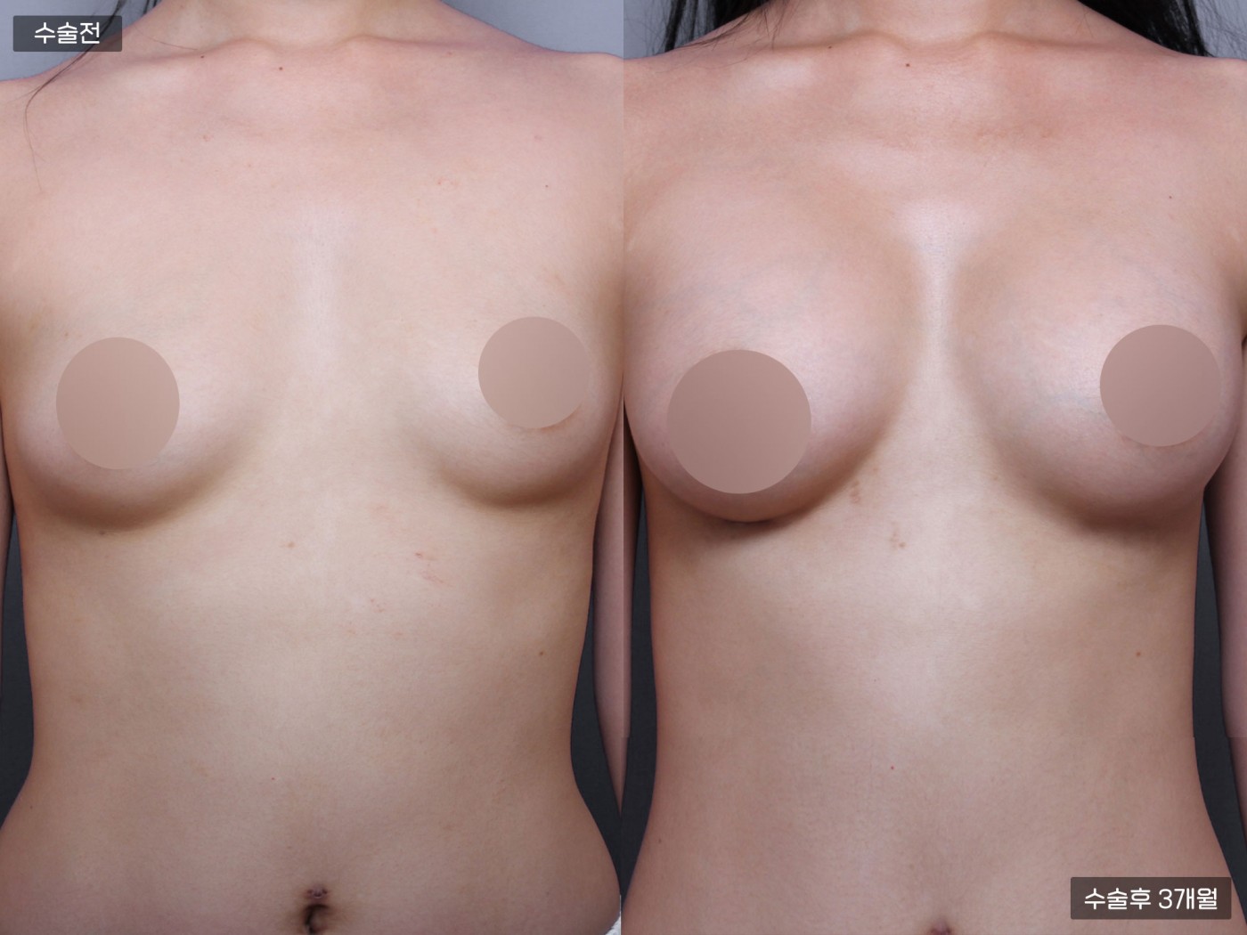 가슴성형 [가슴지방이식]