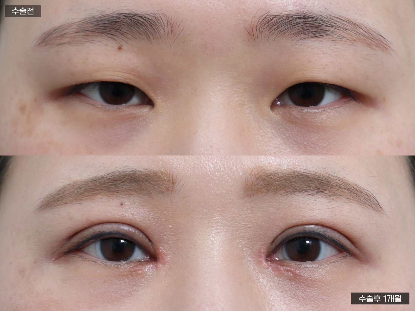 눈성형 [절개 쌍꺼풀 + 앞트임]
