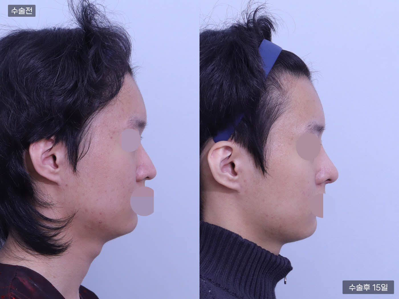 코끝 + 복코 +매부리코 + 콧볼축소