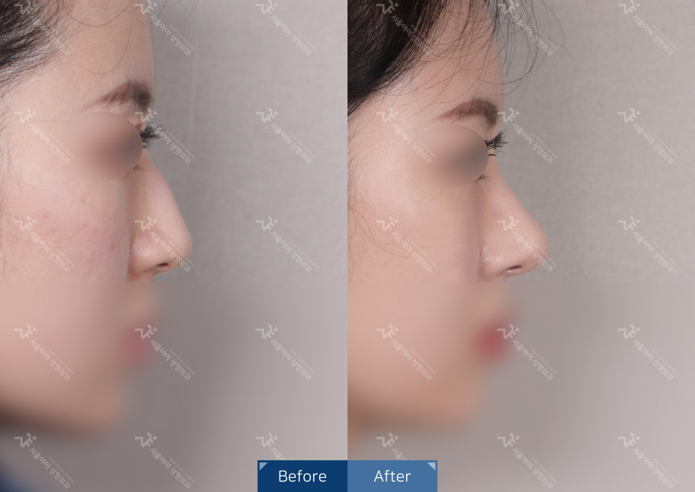 코성형 [코끝조각술+비중격+메부리코+휜코교정술]