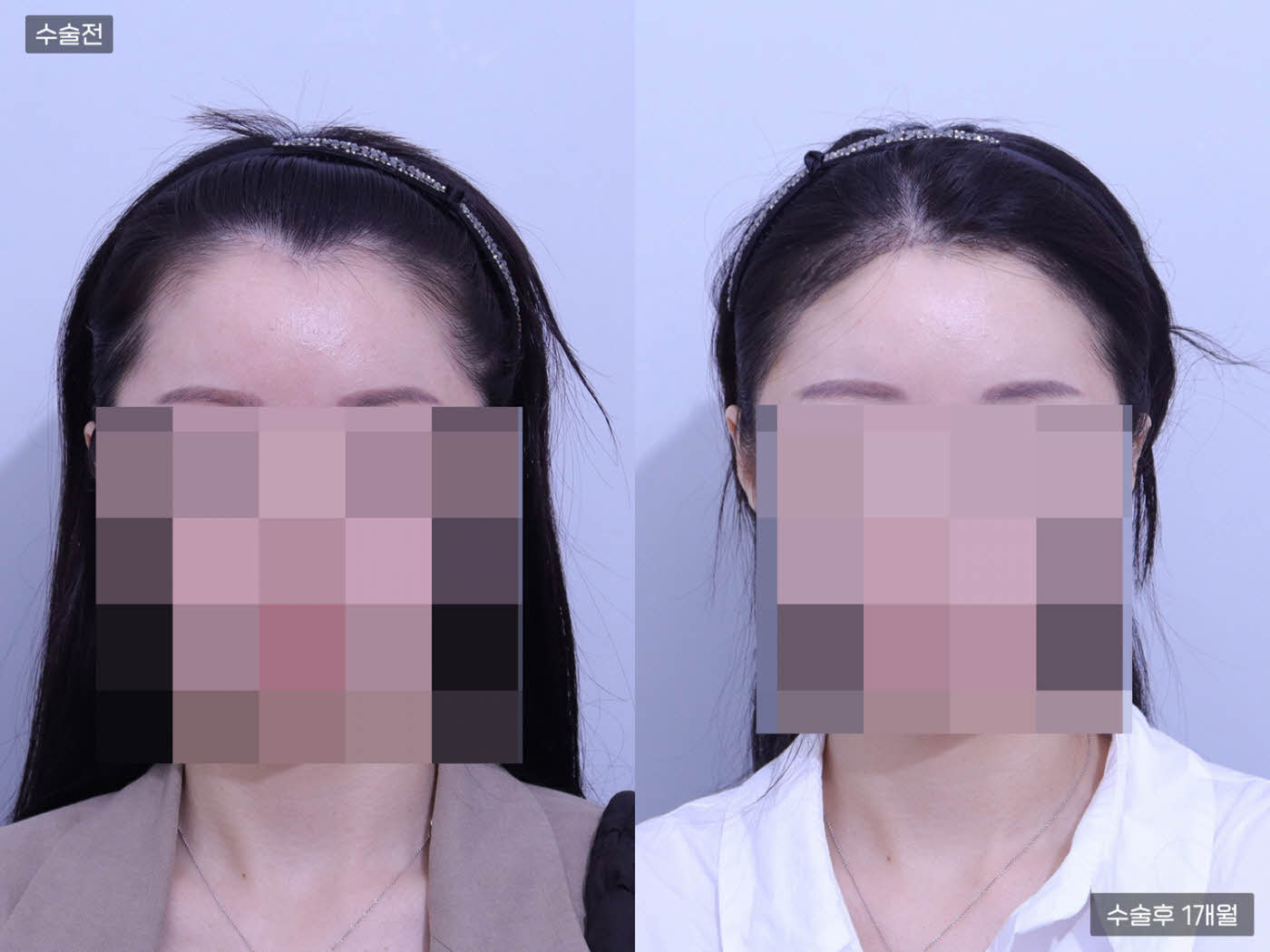 모발이식[절개 모발이식(2000모)]