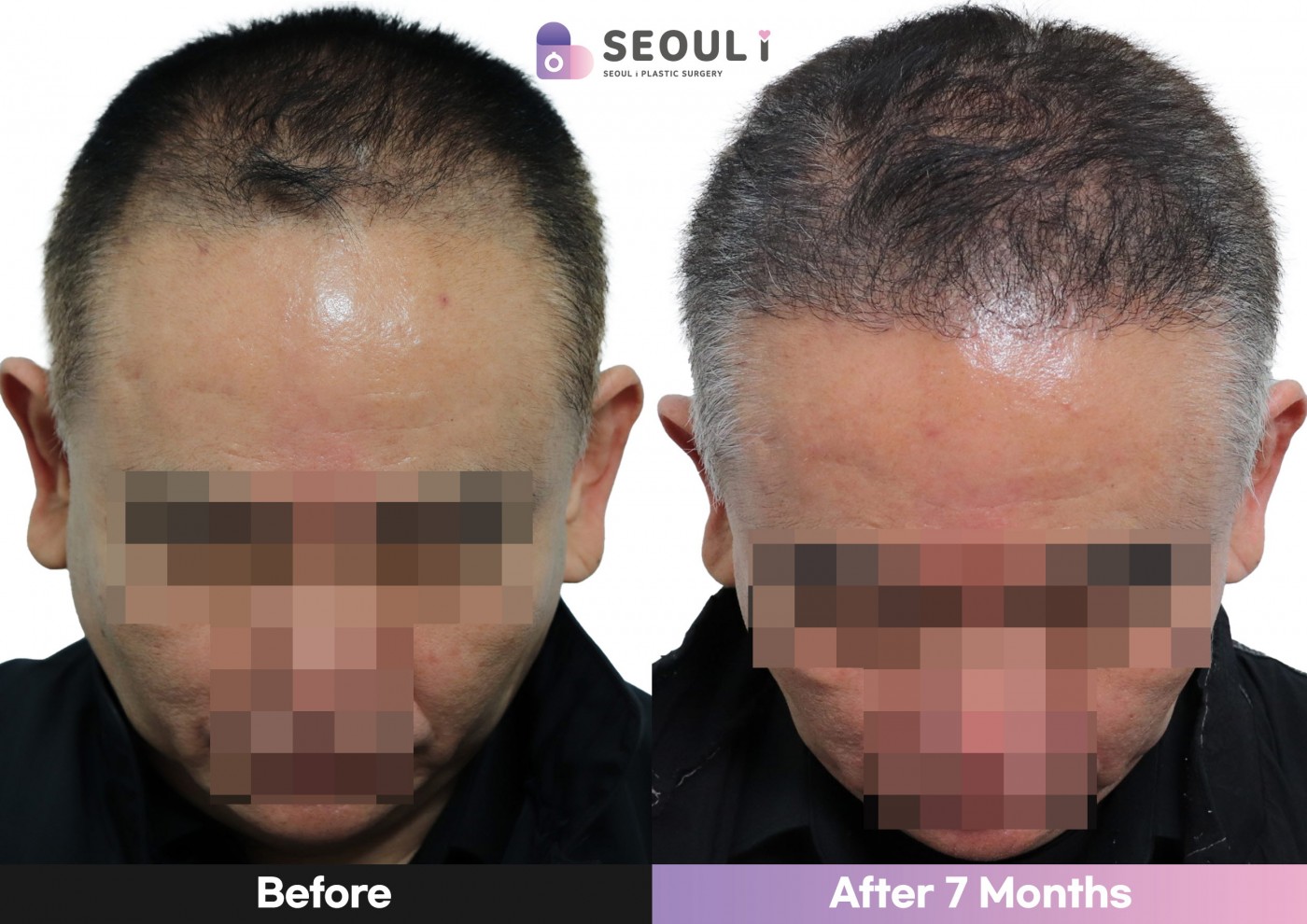 모발이식 [비절개 모발이식(4000모)]