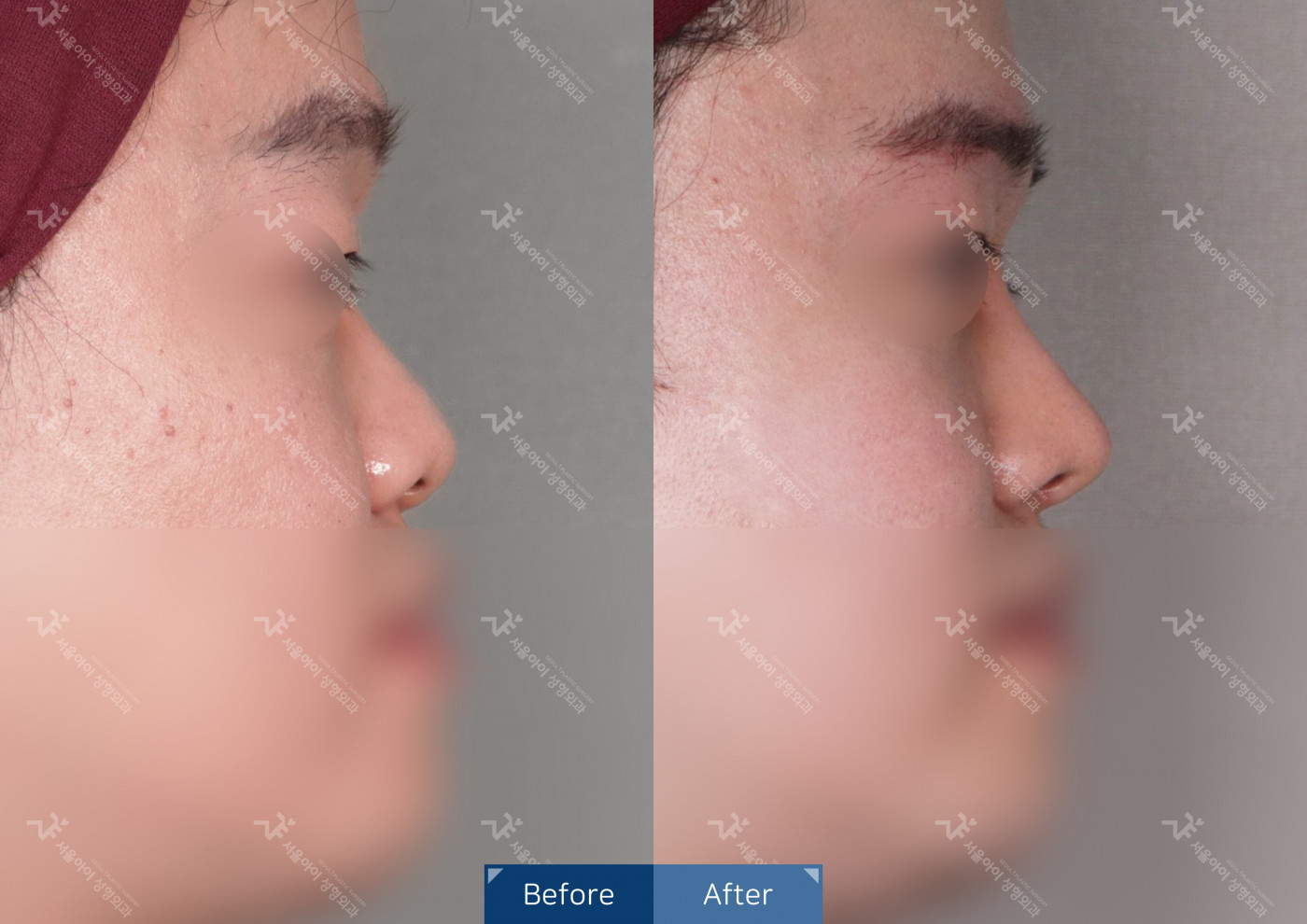 코성형 [코끝조각술+비중격+복코+메부리코]