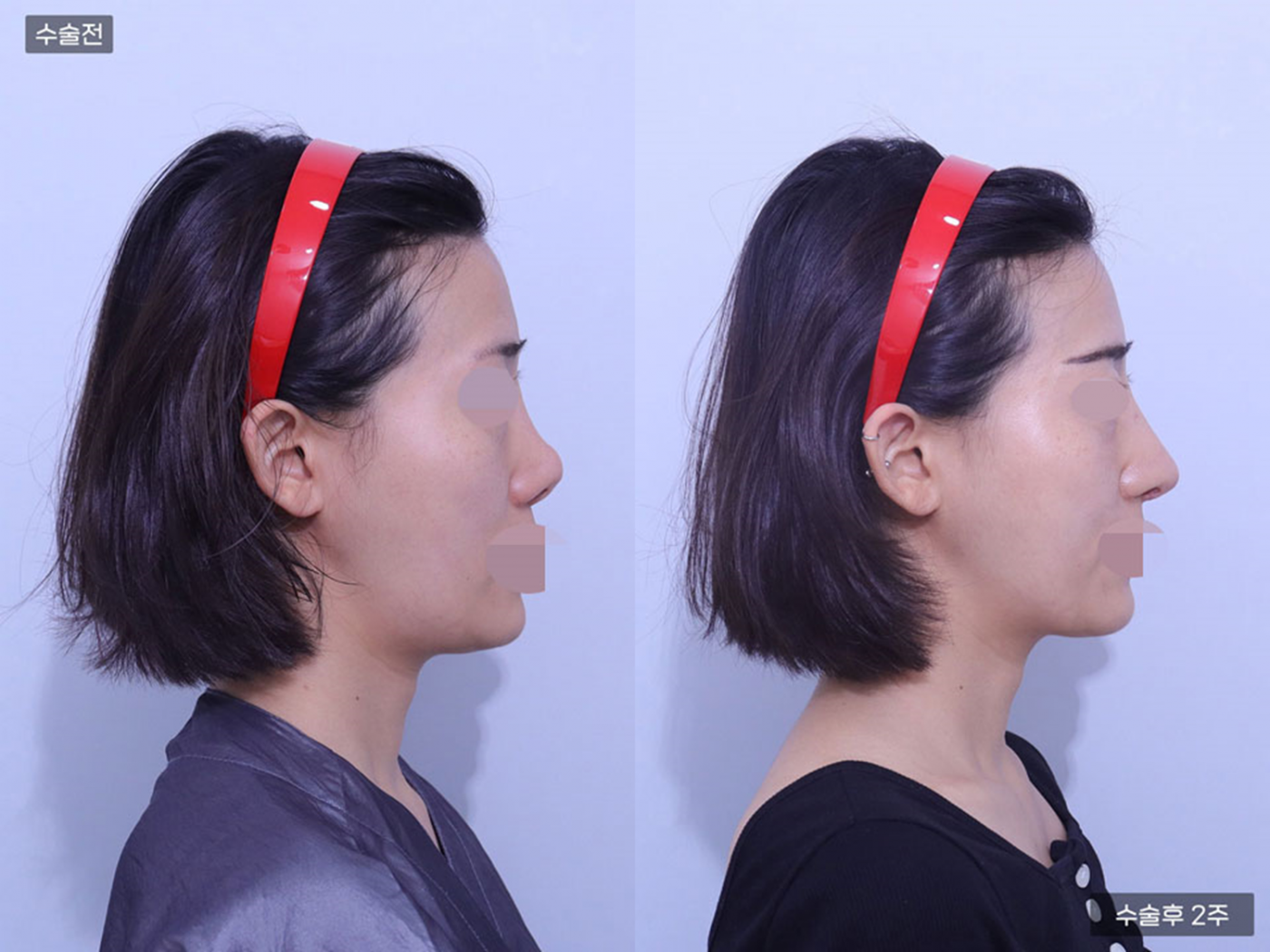 코재수술 + 코끝(비중격) + 복코교정 + 짧은코