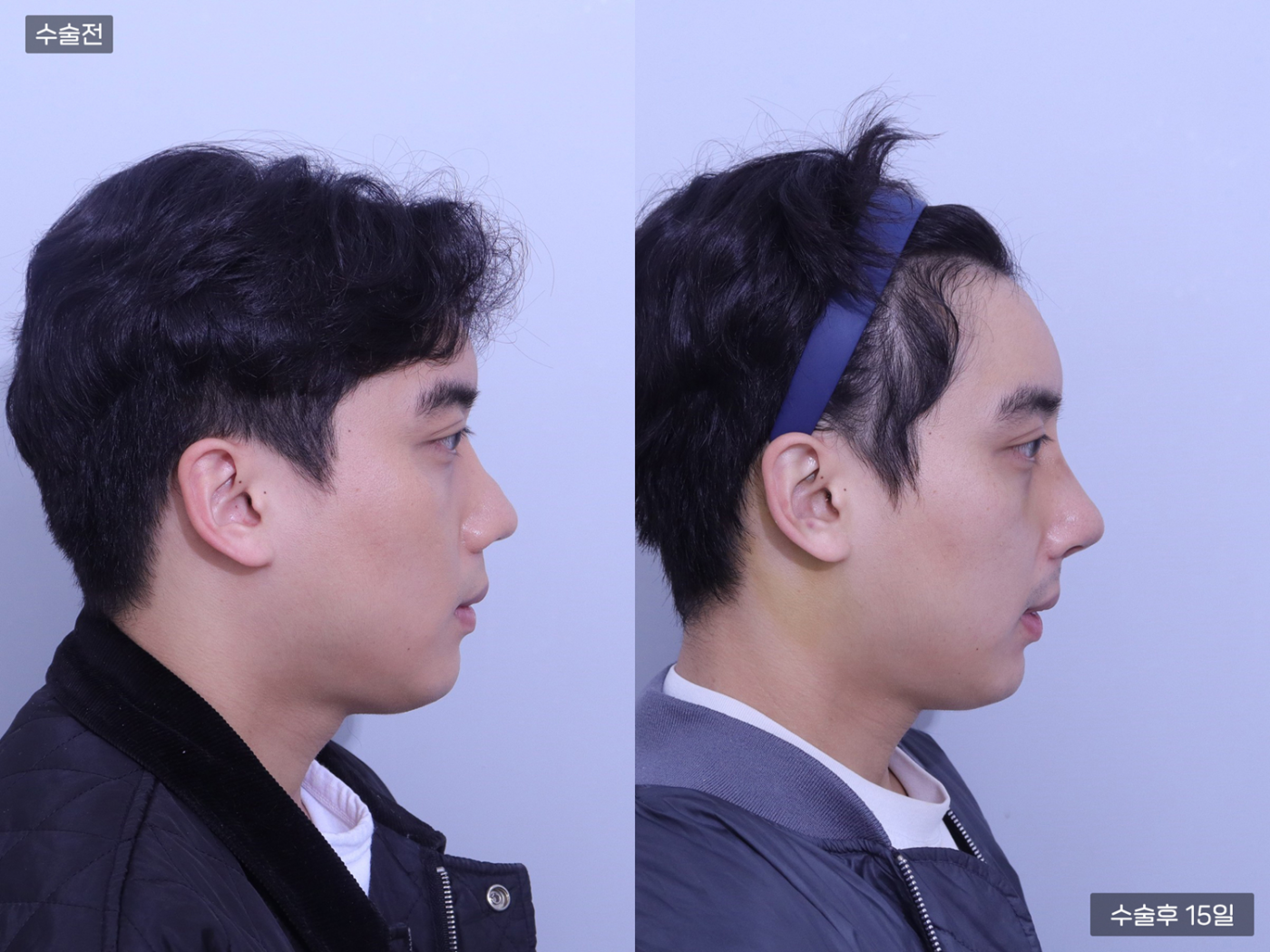 코끝 + 콧볼축소