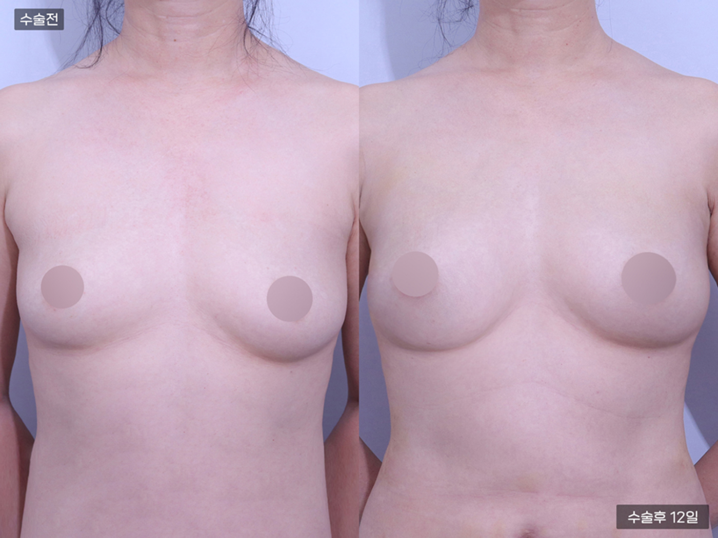 가슴성형 [가슴지방이식(300CC + 300CC)]