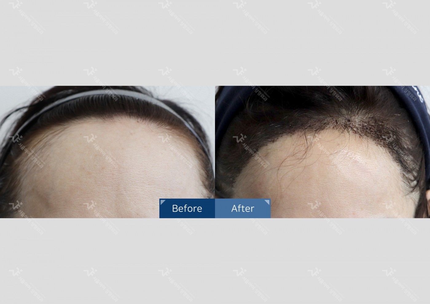 모발이식 [절개 모발이식(3000모)]