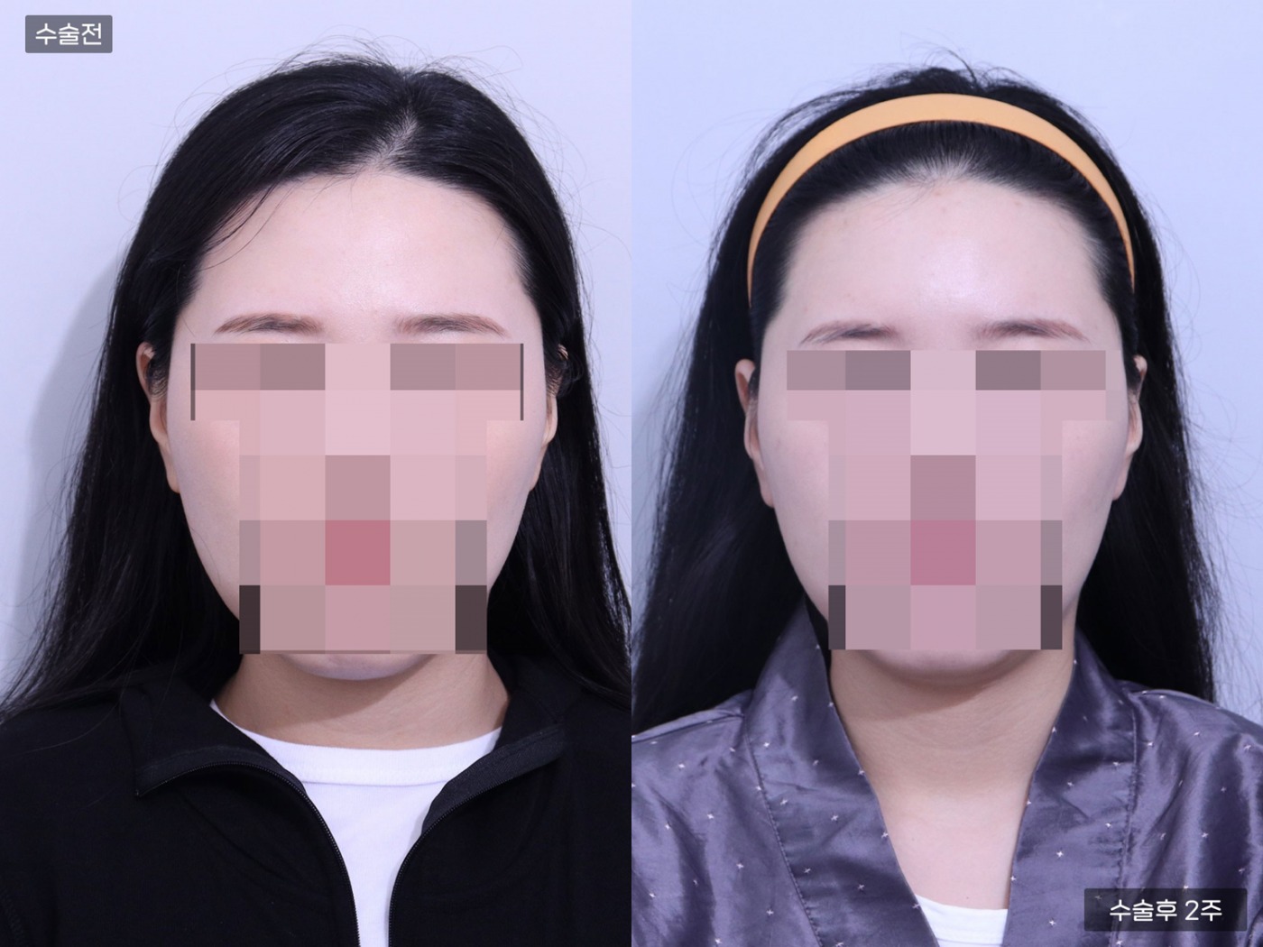 지방이식 [이마]