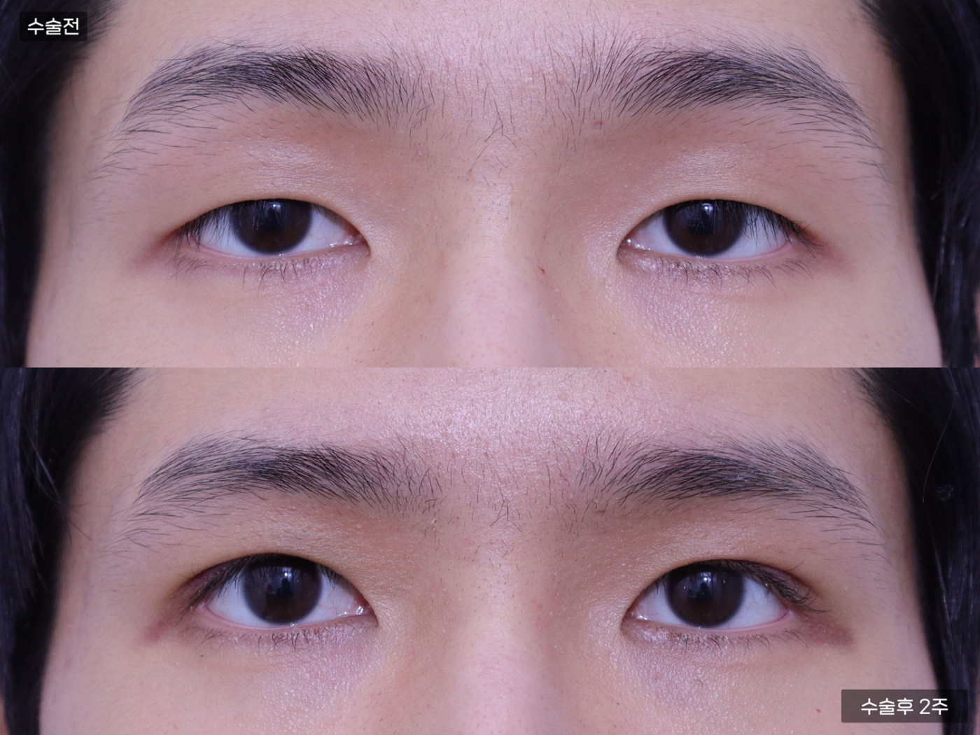 눈성형 [자연유착 쌍꺼풀 + 눈매교정]