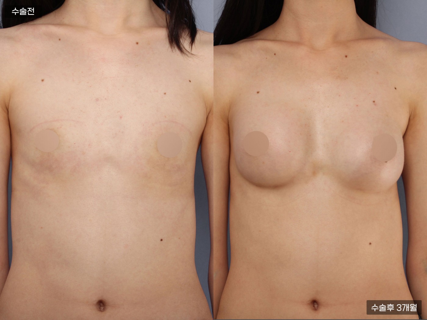 가슴성형 [가슴지방이식]