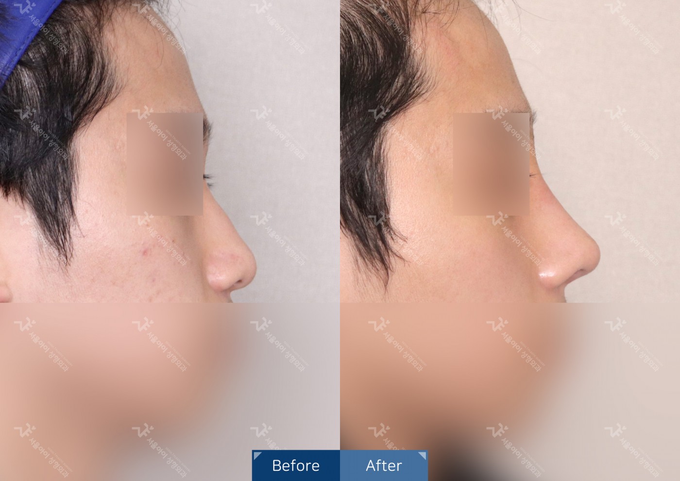 코성형 [융비술&코끝조각술(비중격)]