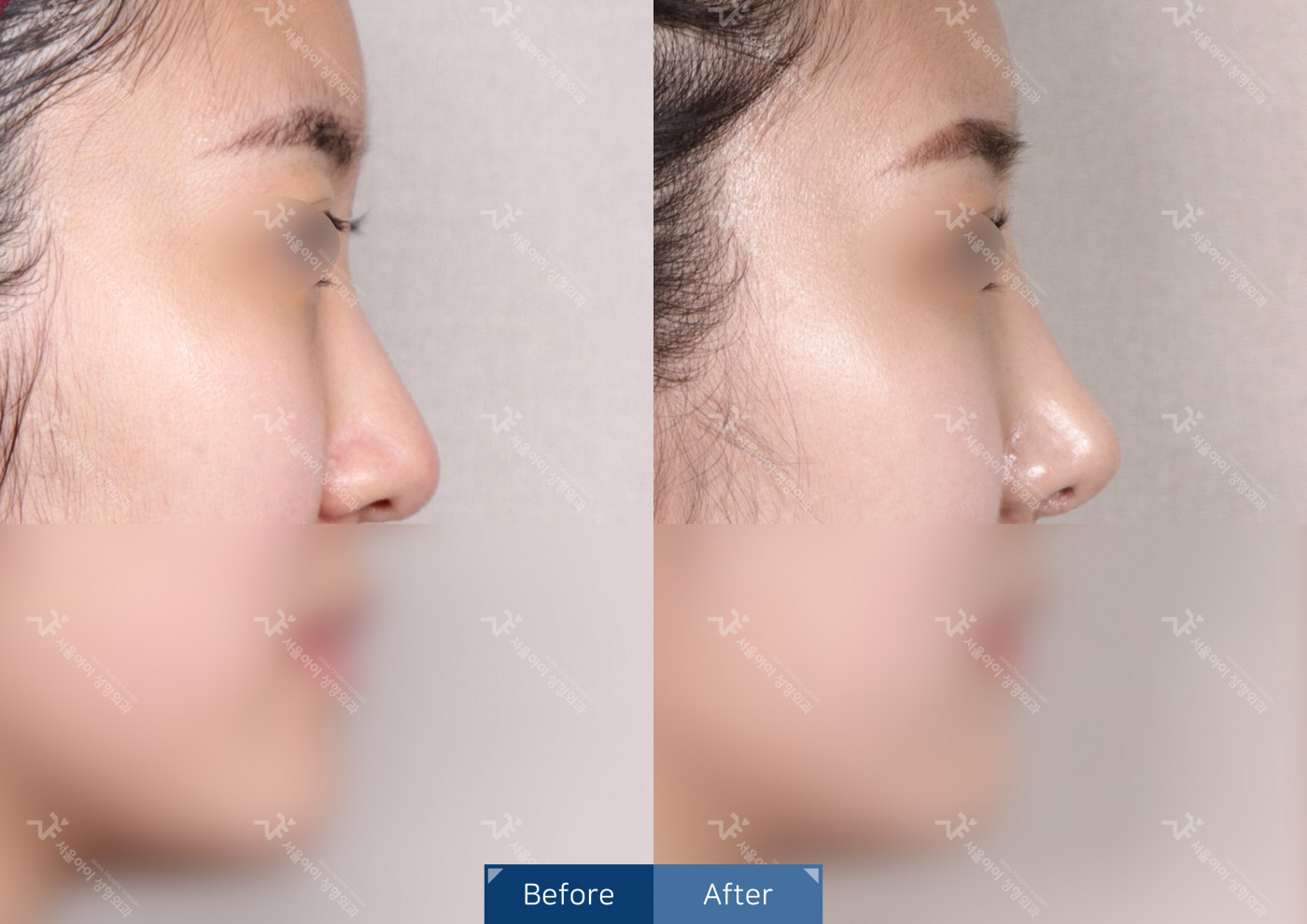 코성형 [융비술&코끝조각술(비중격)+복코교정술+메부리코]