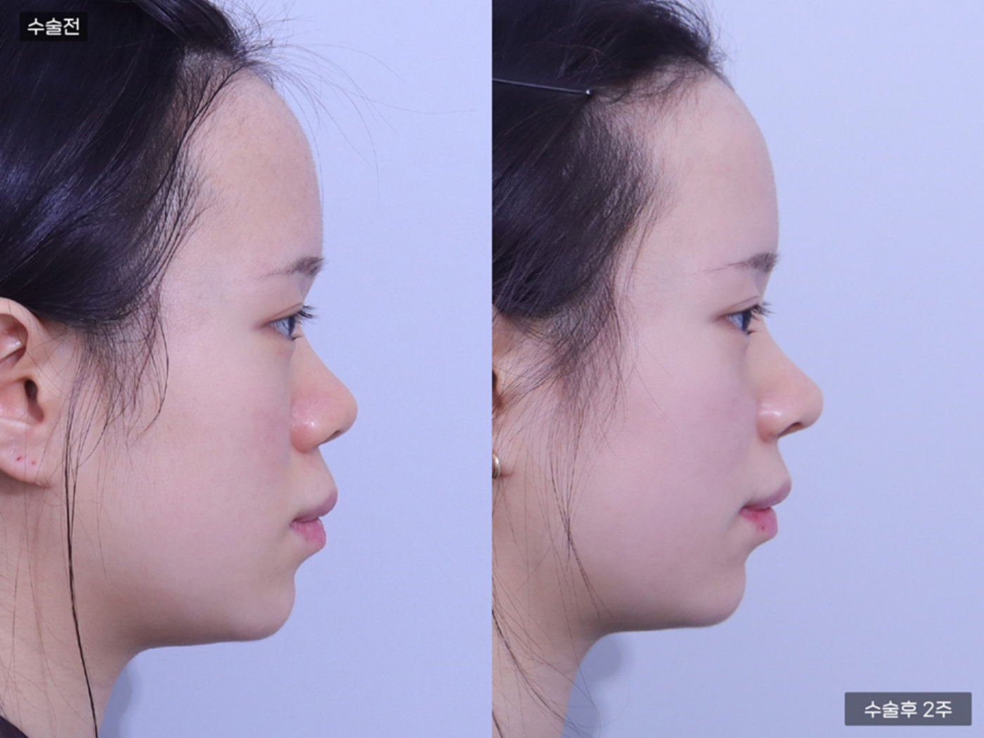 코끝(비중격) + 복코 + 매부리코 + 콧볼축소