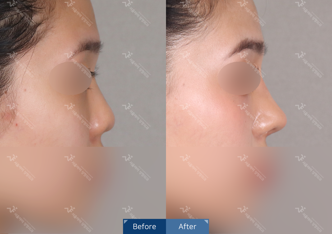 코성형 [기능2종+미용코]