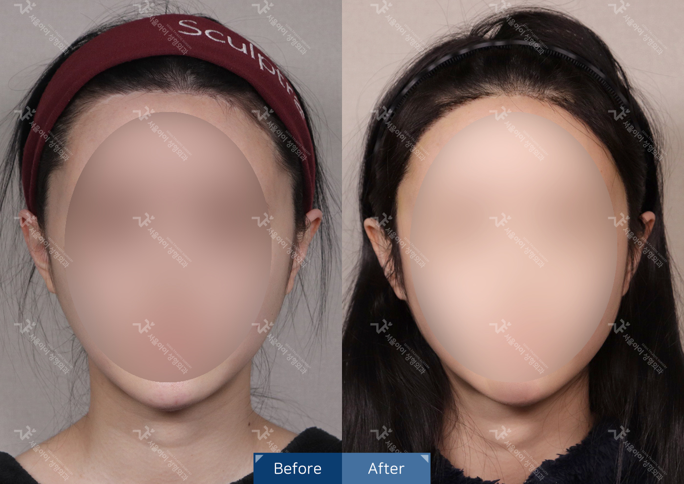 모발이식 [절개 모발이식(3000모) + 헤어라인 + 구렛나루 + 엠자 + 흉터커버]