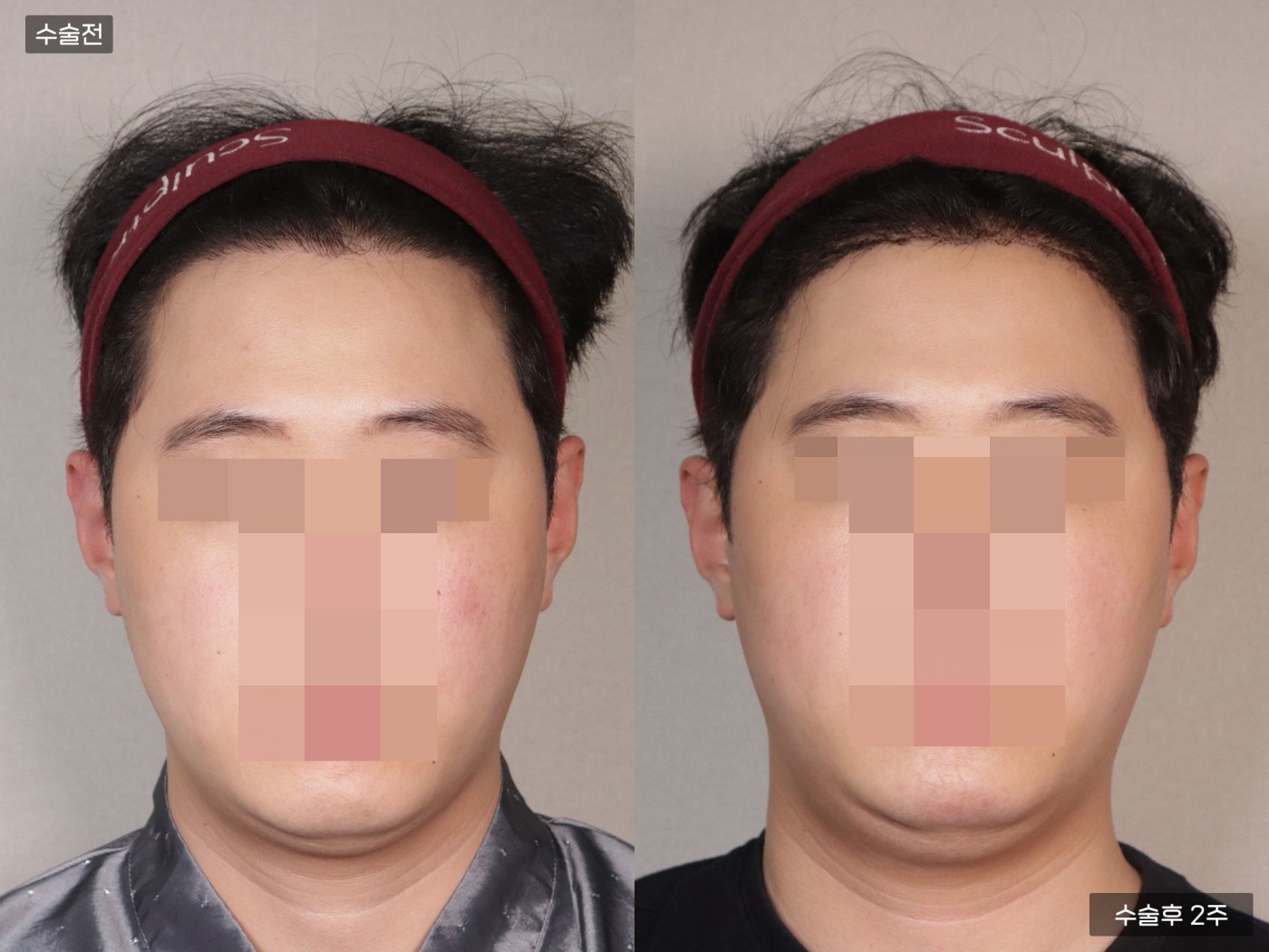 모발이식 [절개 모발이식(4000모)]