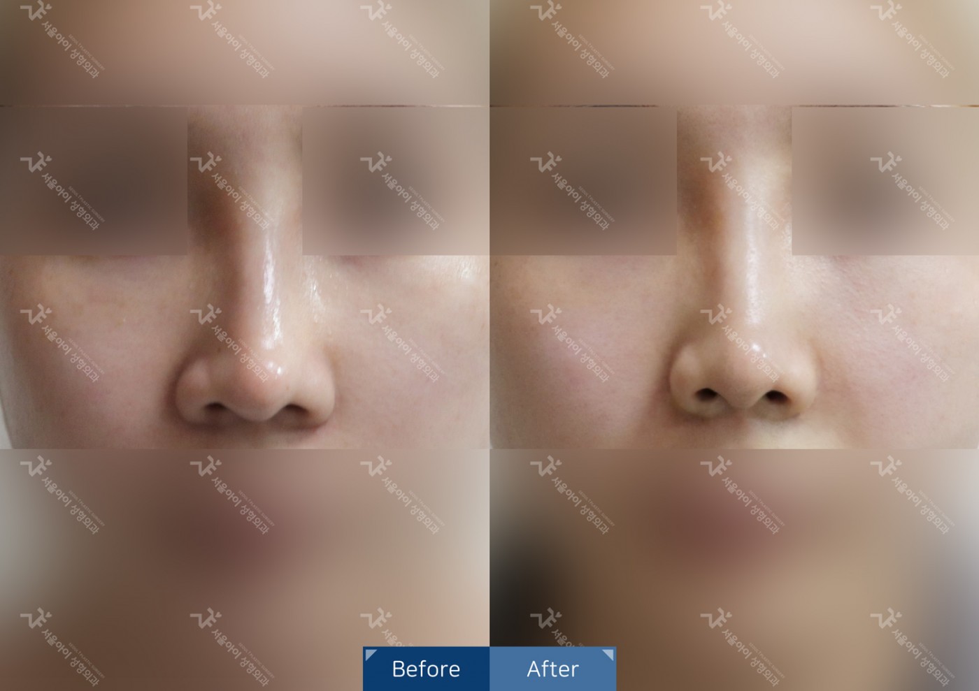 코성형 [비절개콧볼축소]