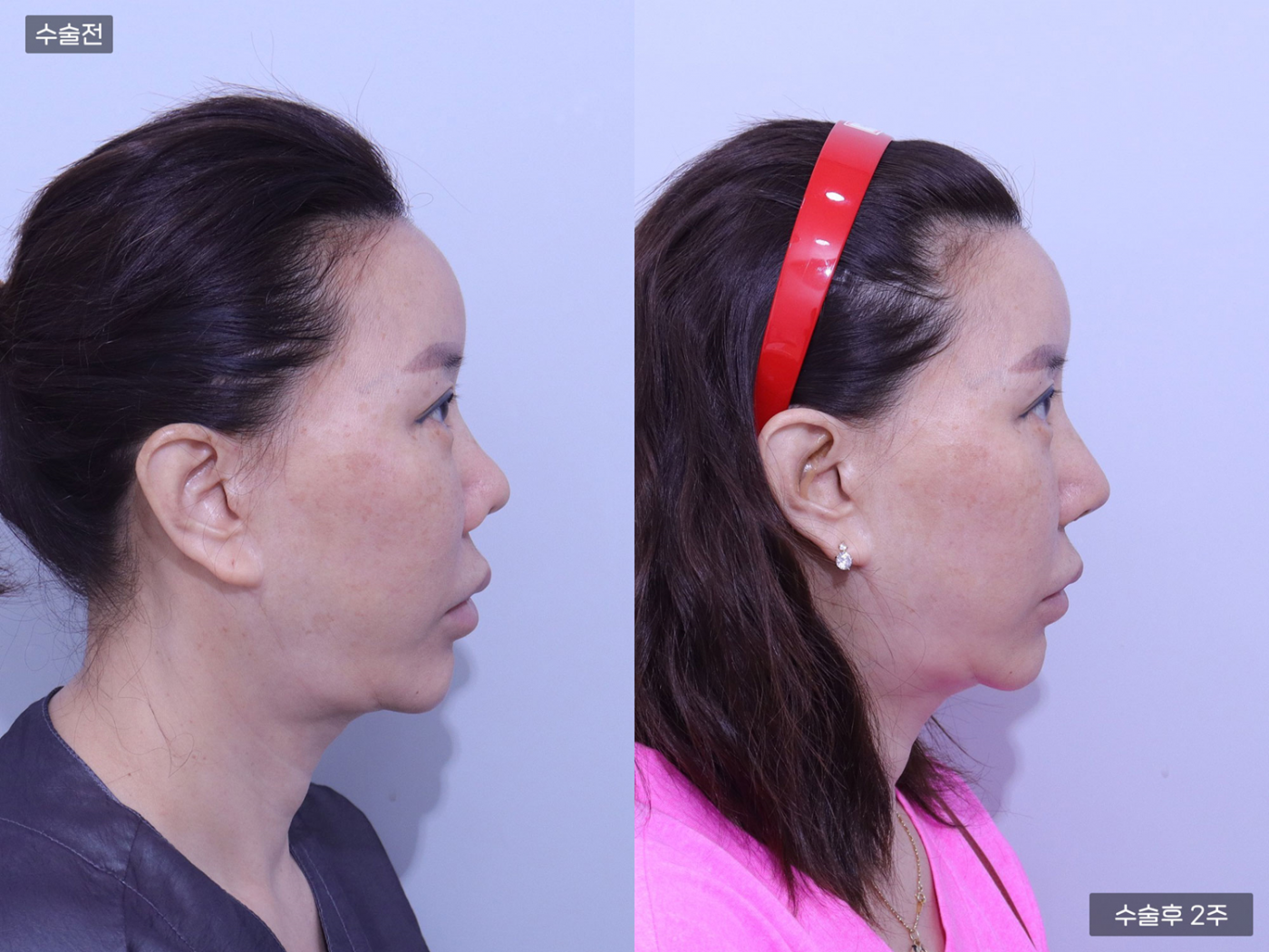 코재수술 + 짧은코 + 콧볼축소 + 비공내리기