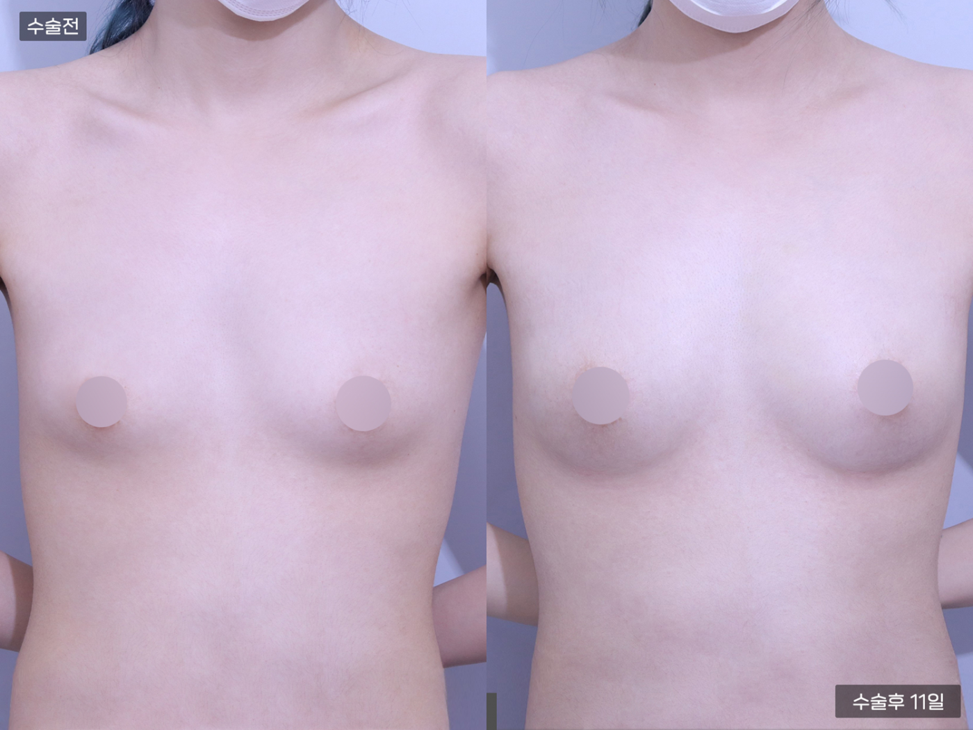 가슴성형 [가슴지방이식(200CC + 200CC)]