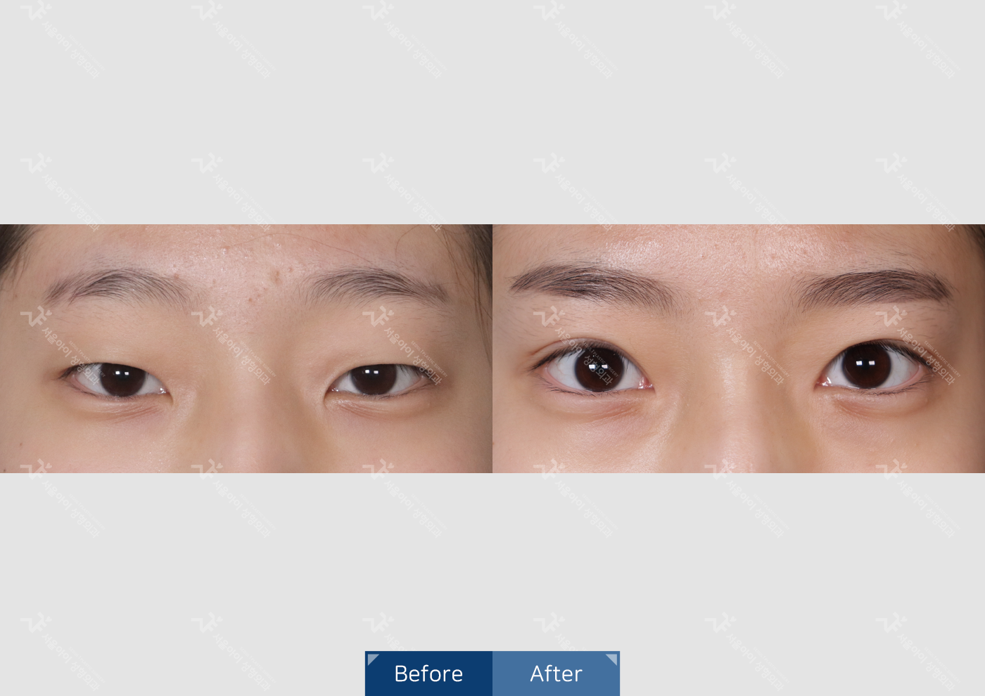 눈성형 [자연유착 쌍꺼풀]