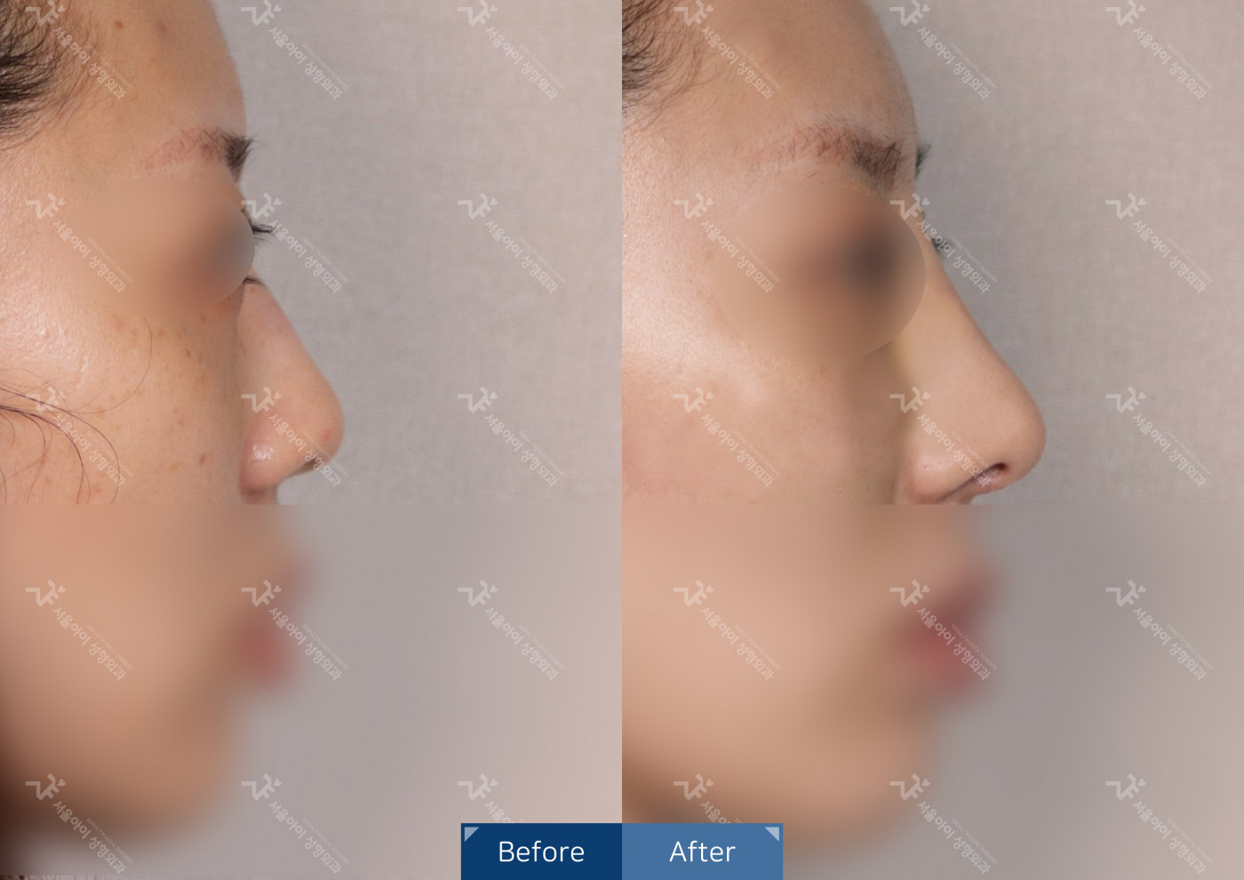 코성형 [융비술&코끝조각술(비중격)+메부리코]