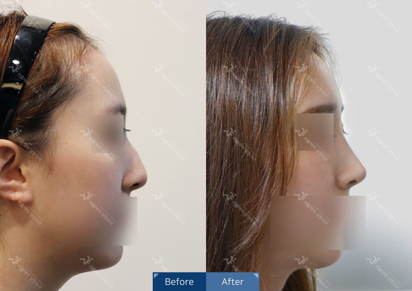 코성형 [메부리코+축비술+복코교정술+코끝조각술]