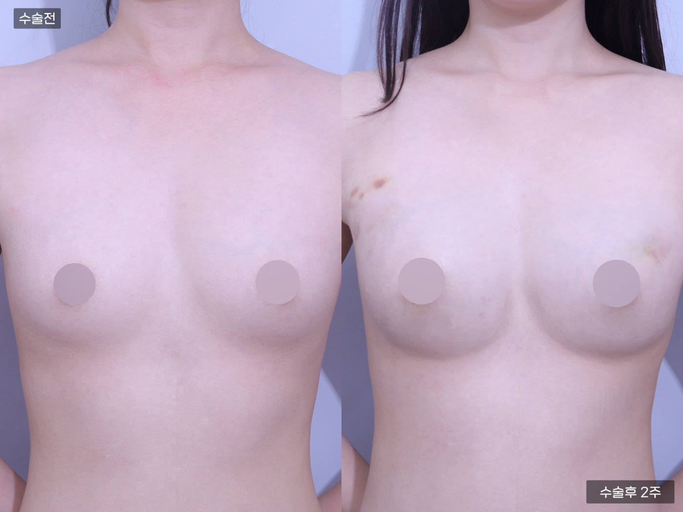 가슴성형 [가슴지방이식(250CC + 250CC)]