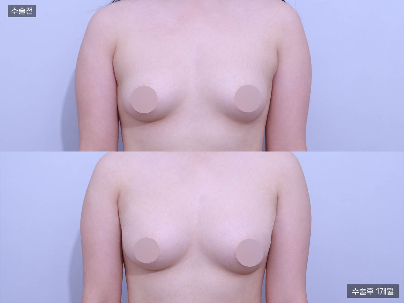 지방흡입(팔) + (300cc+300cc)가슴지방이식