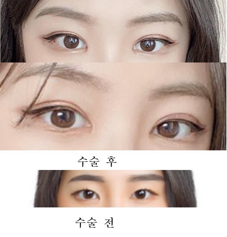 매몰 앞뒤트 후기!!