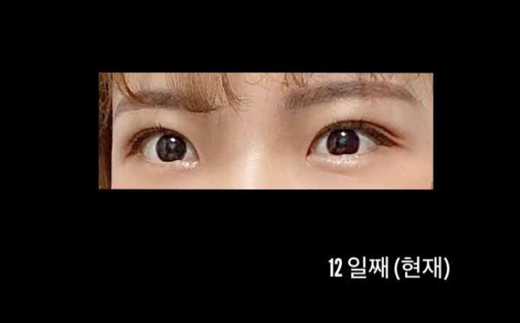 수술후기이미지