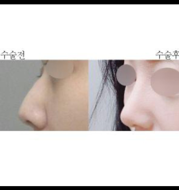 매부리코 수술 후기입니다아~~~