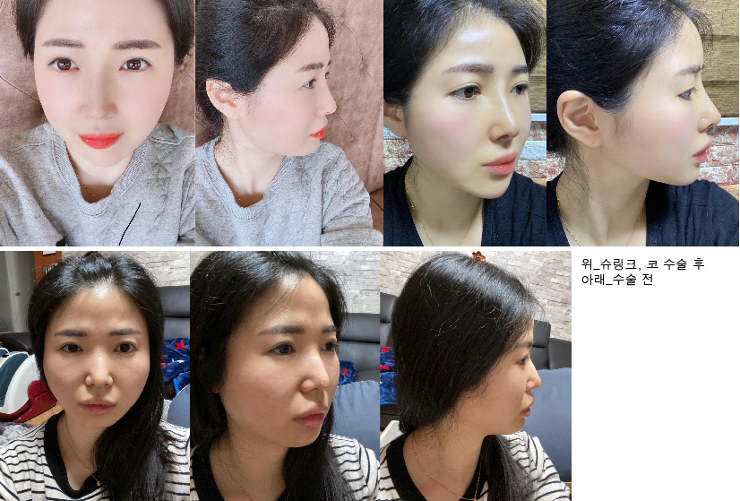 수술후기이미지