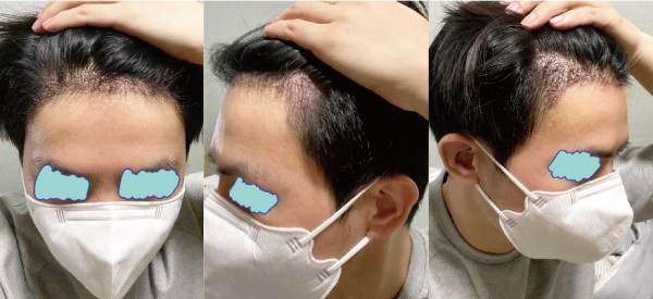 모발이식하고 왔습니다ㅎ