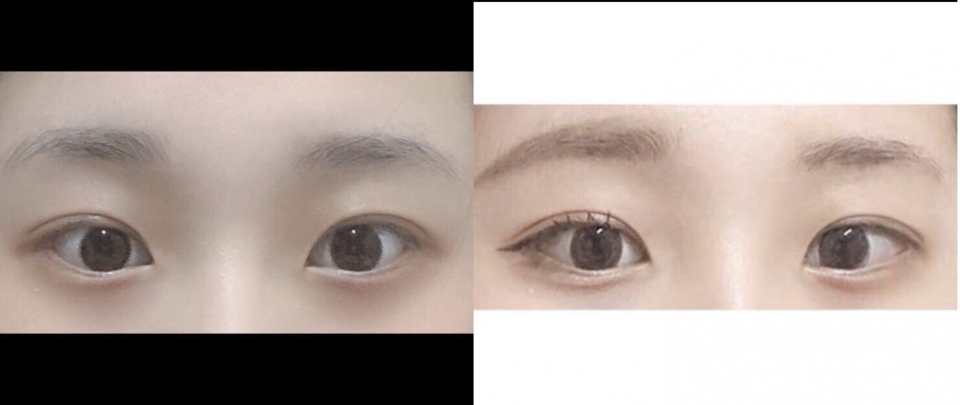 수술후기이미지