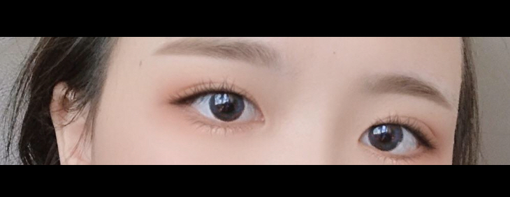 수술후기이미지