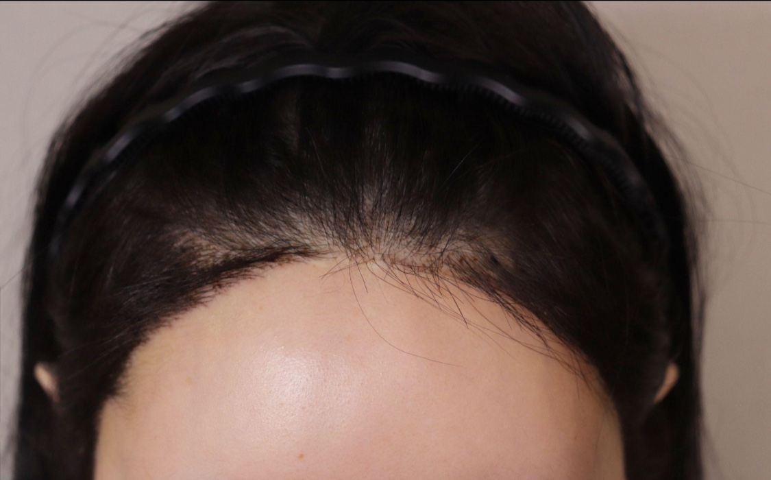 수술후기이미지