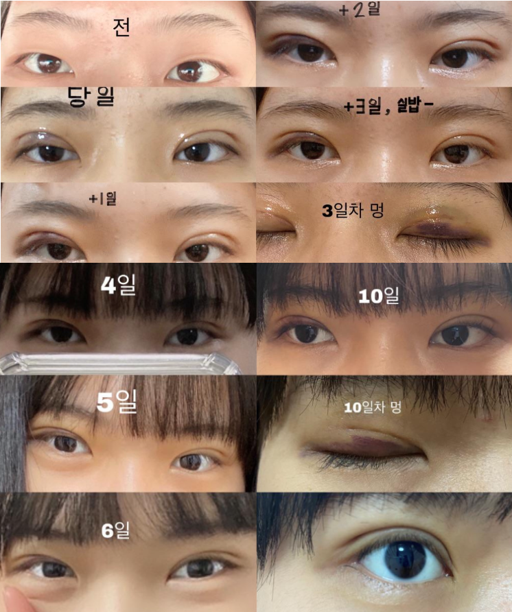 수술후기이미지